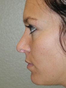 Rhinoplasty After Photo by Michael Epstein, MD, FACS; Northbrook, IL - Case 27720