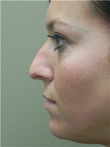 Rhinoplasty Before Photo by Michael Epstein, MD, FACS; Northbrook, IL - Case 27720