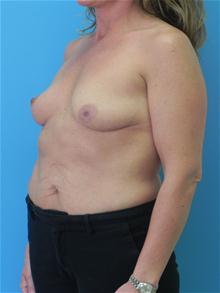 Breast Augmentation Before Photo by Michael Epstein, MD, FACS; Northbrook, IL - Case 27878