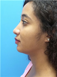 Rhinoplasty After Photo by Michael Epstein, MD, FACS; Northbrook, IL - Case 30979