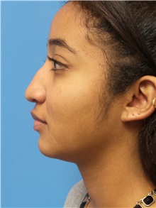 Rhinoplasty Before Photo by Michael Epstein, MD, FACS; Northbrook, IL - Case 30979