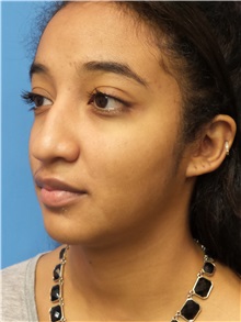 Rhinoplasty Before Photo by Michael Epstein, MD, FACS; Northbrook, IL - Case 30979