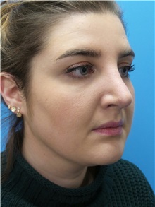 Rhinoplasty After Photo by Michael Epstein, MD, FACS; Northbrook, IL - Case 31031