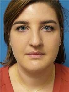 Rhinoplasty Before Photo by Michael Epstein, MD, FACS; Northbrook, IL - Case 31031