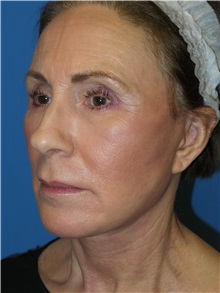 Facelift After Photo by Michael Epstein, MD, FACS; Northbrook, IL - Case 31054
