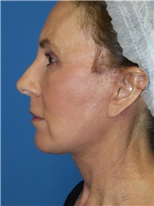 Facelift After Photo by Michael Epstein, MD, FACS; Northbrook, IL - Case 31054