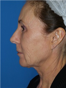 Facelift Before Photo by Michael Epstein, MD, FACS; Northbrook, IL - Case 31054