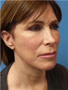 Facelift After Photo by Michael Epstein, MD, FACS; Northbrook, IL - Case 31057