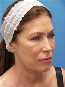 Facelift Before Photo by Michael Epstein, MD, FACS; Northbrook, IL - Case 31057