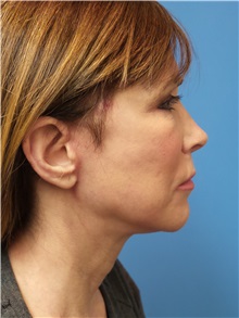 Facelift After Photo by Michael Epstein, MD, FACS; Northbrook, IL - Case 31057
