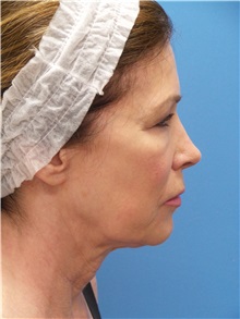 Facelift Before Photo by Michael Epstein, MD, FACS; Northbrook, IL - Case 31057