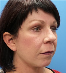 Facelift After Photo by Michael Epstein, MD, FACS; Northbrook, IL - Case 31059