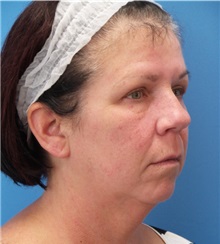 Facelift Before Photo by Michael Epstein, MD, FACS; Northbrook, IL - Case 31059