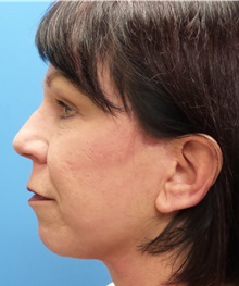 Facelift After Photo by Michael Epstein, MD, FACS; Northbrook, IL - Case 31059
