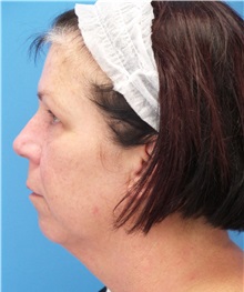 Facelift Before Photo by Michael Epstein, MD, FACS; Northbrook, IL - Case 31059