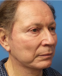 Facelift After Photo by Michael Epstein, MD, FACS; Northbrook, IL - Case 31060