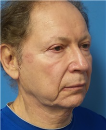 Facelift Before Photo by Michael Epstein, MD, FACS; Northbrook, IL - Case 31060