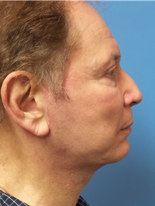 Facelift After Photo by Michael Epstein, MD, FACS; Northbrook, IL - Case 31060