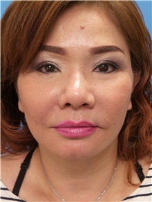 Facelift After Photo by Michael Epstein, MD, FACS; Northbrook, IL - Case 31066