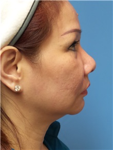 Facelift Before Photo by Michael Epstein, MD, FACS; Northbrook, IL - Case 31066