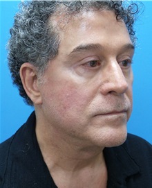 Facelift After Photo by Michael Epstein, MD, FACS; Northbrook, IL - Case 31453