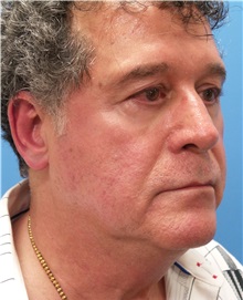 Facelift Before Photo by Michael Epstein, MD, FACS; Northbrook, IL - Case 31453