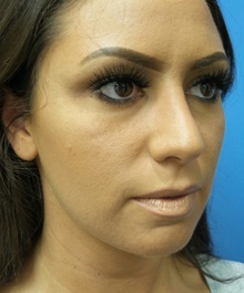 Rhinoplasty After Photo by Michael Epstein, MD, FACS; Northbrook, IL - Case 31771
