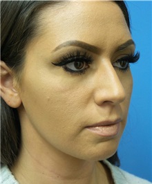 Rhinoplasty Before Photo by Michael Epstein, MD, FACS; Northbrook, IL - Case 31771