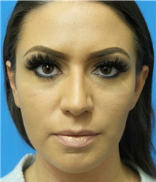 Rhinoplasty Before Photo by Michael Epstein, MD, FACS; Northbrook, IL - Case 31771