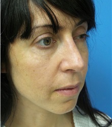 Rhinoplasty After Photo by Michael Epstein, MD, FACS; Northbrook, IL - Case 32016
