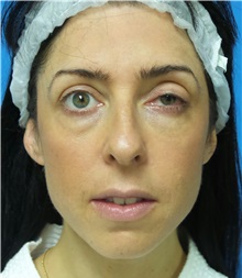 Rhinoplasty Before Photo by Michael Epstein, MD, FACS; Northbrook, IL - Case 32016