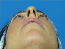 Rhinoplasty Before Photo by Michael Epstein, MD, FACS; Northbrook, IL - Case 32016