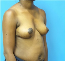 Breast Lift After Photo by Michael Epstein, MD, FACS; Northbrook, IL - Case 32266