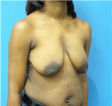 Breast Lift Before Photo by Michael Epstein, MD, FACS; Northbrook, IL - Case 32266