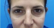 Eyelid Surgery After Photo by Michael Epstein, MD, FACS; Northbrook, IL - Case 32351