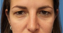 Eyelid Surgery Before Photo by Michael Epstein, MD, FACS; Northbrook, IL - Case 32351