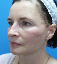 Facelift After Photo by Michael Epstein, MD, FACS; Northbrook, IL - Case 32396