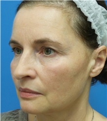 Facelift Before Photo by Michael Epstein, MD, FACS; Northbrook, IL - Case 32396