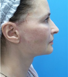 Facelift After Photo by Michael Epstein, MD, FACS; Northbrook, IL - Case 32396