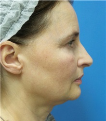 Facelift Before Photo by Michael Epstein, MD, FACS; Northbrook, IL - Case 32396