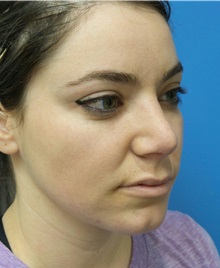 Rhinoplasty After Photo by Michael Epstein, MD, FACS; Northbrook, IL - Case 32413