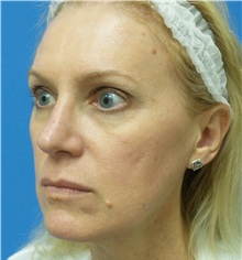 Rhinoplasty After Photo by Michael Epstein, MD, FACS; Northbrook, IL - Case 32823