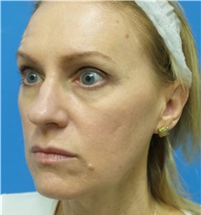 Rhinoplasty Before Photo by Michael Epstein, MD, FACS; Northbrook, IL - Case 32823