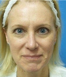 Rhinoplasty After Photo by Michael Epstein, MD, FACS; Northbrook, IL - Case 32823