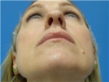 Rhinoplasty Before Photo by Michael Epstein, MD, FACS; Northbrook, IL - Case 32823