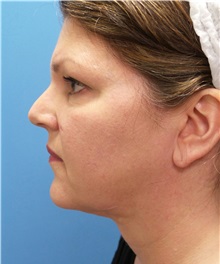 Liposuction After Photo by Michael Epstein, MD, FACS; Northbrook, IL - Case 32918