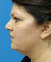 Liposuction Before Photo by Michael Epstein, MD, FACS; Northbrook, IL - Case 32918