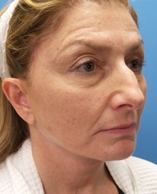 Facelift After Photo by Michael Epstein, MD, FACS; Northbrook, IL - Case 32923