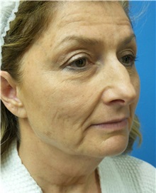 Facelift Before Photo by Michael Epstein, MD, FACS; Northbrook, IL - Case 32923