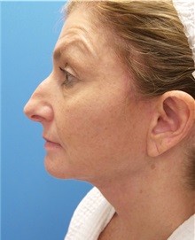 Facelift After Photo by Michael Epstein, MD, FACS; Northbrook, IL - Case 32923